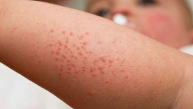 Аллергия у ребенка на Нурофен 1675757641342