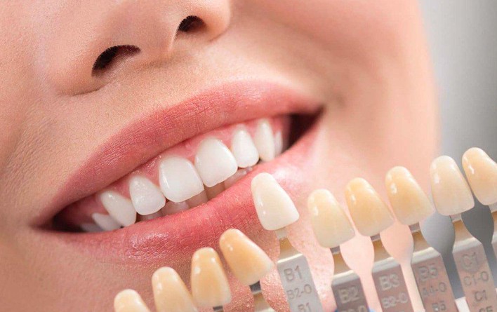 Виниры E-max для зубов в Тюмени  1694071313909